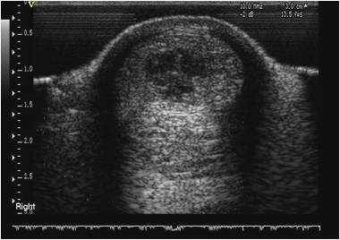 Figure 2: Ultrasonography image showing a core lesion within the superficial digital flexor tendon