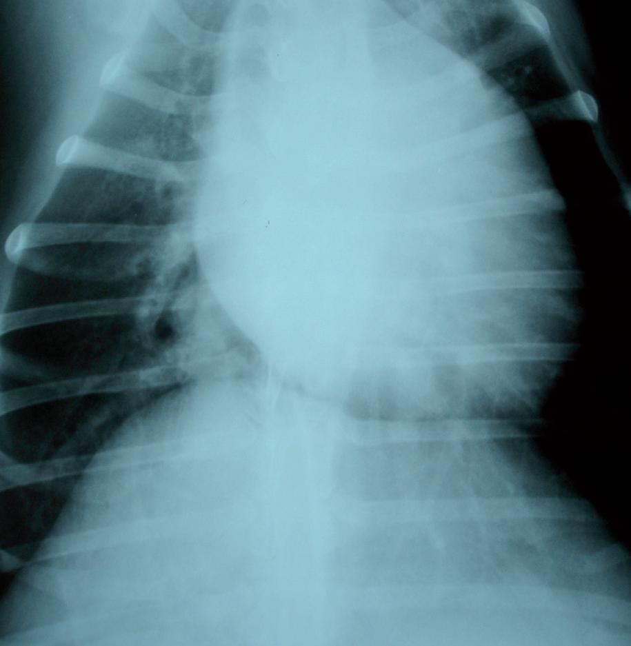 Figure 2: dorsoventral thoracic radiography