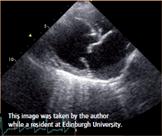 Figure 3: right parasternal long axis echo image